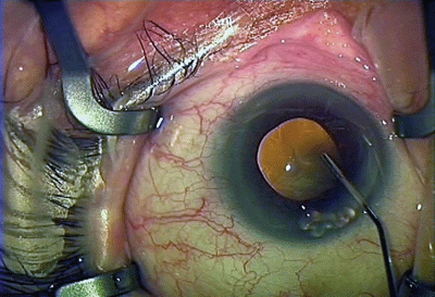 unequal pupil size after cataract surgery